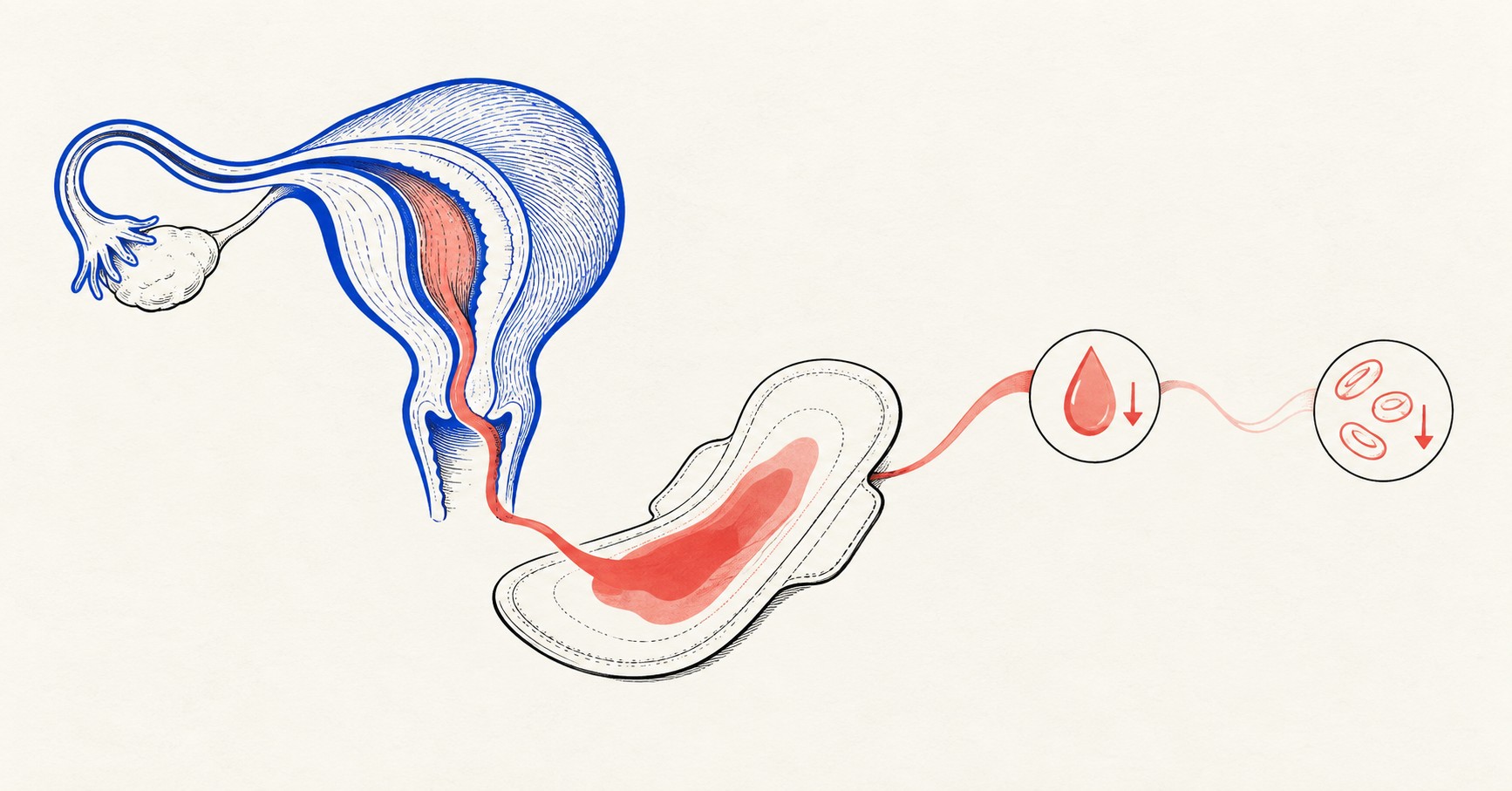 자궁선근증의 과다월경과 철결핍빈혈을 연결한 여성 건강 의료 일러스트